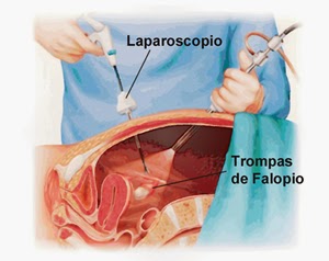 Cesarea y ligadura de trompas consecuencias Cesarea y ligadura de trompas consecuencias