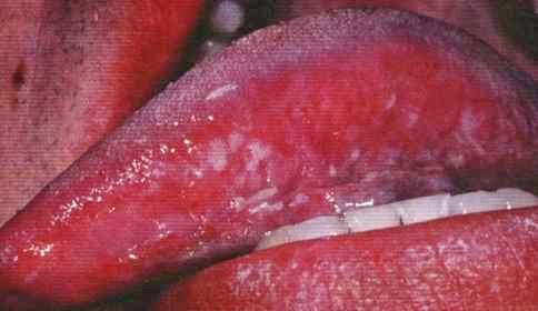 tratamiento natural candidiasis esofagica tratamiento natural candidiasis esofagica