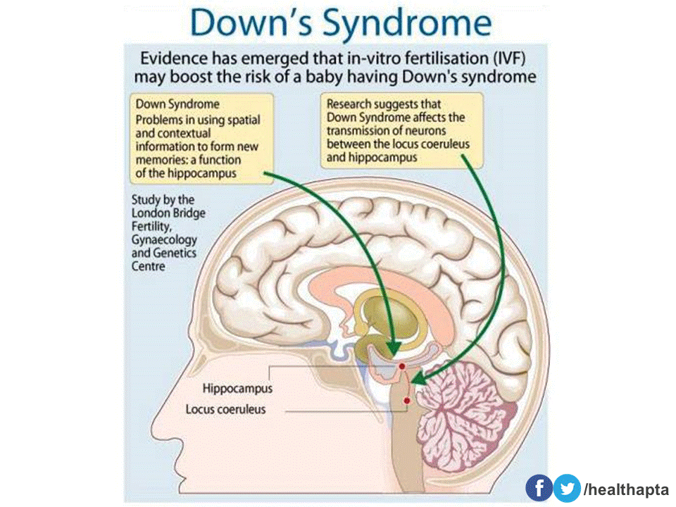 Brain down. Мозг человека с синдромом Дауна. Строение мозга при синдроме Дауна.