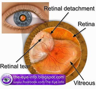 ما هو مرض انفصال الشبكية ؟ - The eye