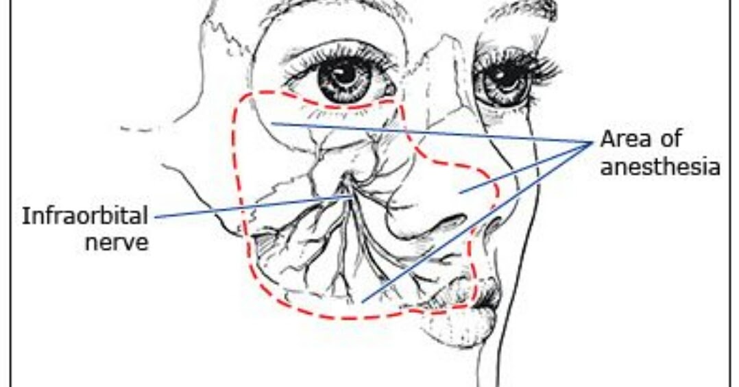 INFRAORBITAL NERVE BLOCK