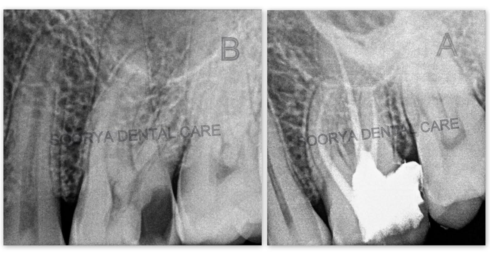 Best Dental Hospital in Karaikudi BEST ROOT CANAL TREATMENT IN KARAIKUDI