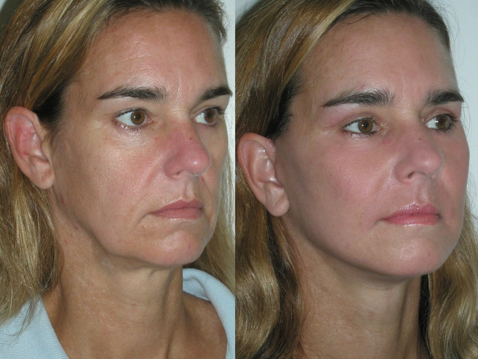 NonInvasive Facelifts And Yoga Facial Exercises Remedy Flaccid Jowls