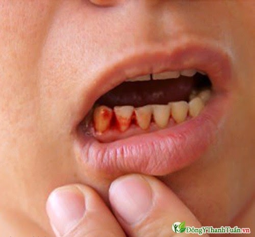 bệnh chảy máu chân răng
