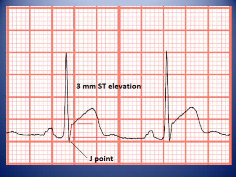 telemetry technician course measuring st elevation and ekg graph paper