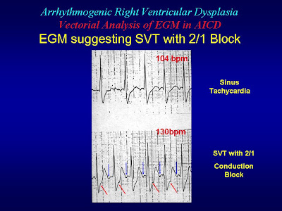 ARVCsGF: Vectorial interpretation of VT/SVT signals stored in the ICD