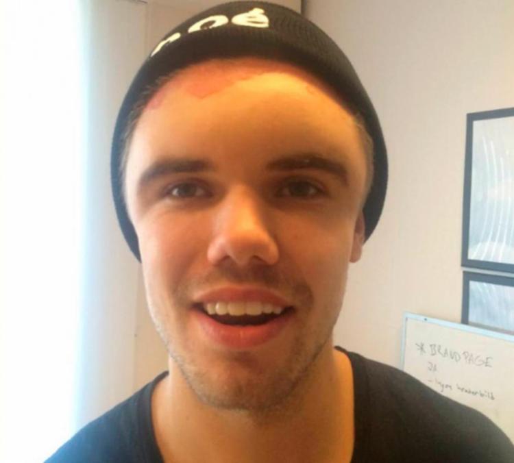 Após tingir cabelo, jovem tem reação alérgica e sua cabeça infla