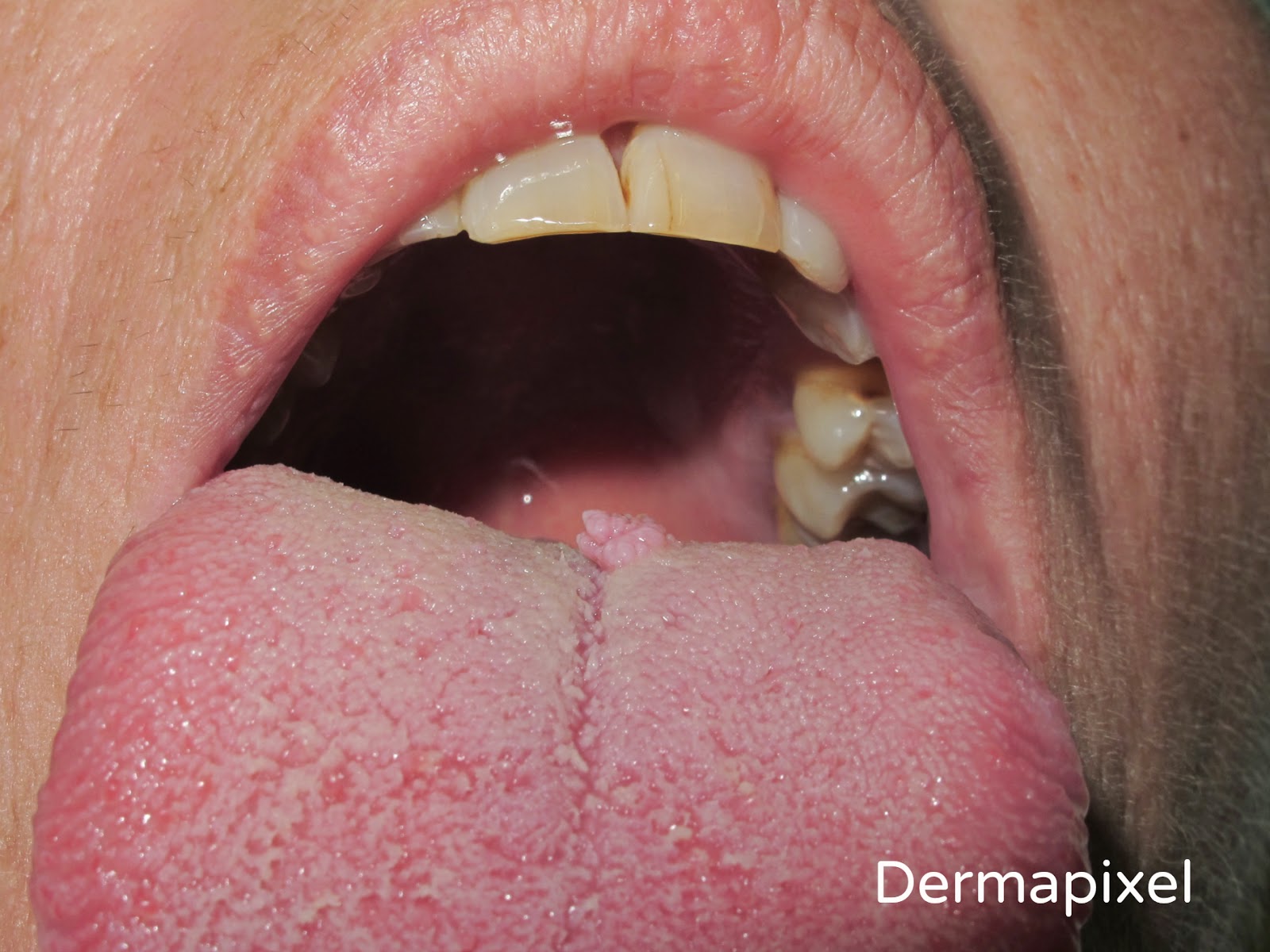 Lesion de papiloma en boca - Sintomas virus papiloma en boca, Papilloma virus e herpes