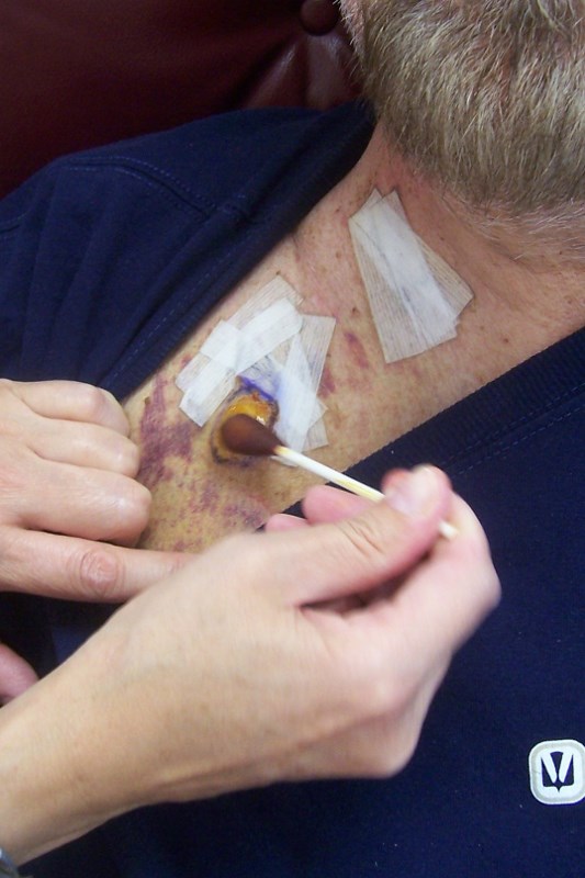 Stage 4 Lung Cancer >> My Lung Cancer Odyssey Stage 4 Lung Cancer Pratfalls Stage 4 Lung Cancer >> My Lung Cancer Odyssey Stage 4 Lung Cancer Pratfalls