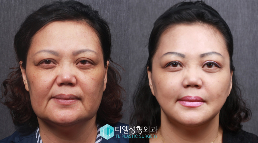 SMAS FACELIFT TL ANTIAGING LIFTING KOREA