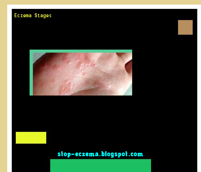 Stages Of Eczema