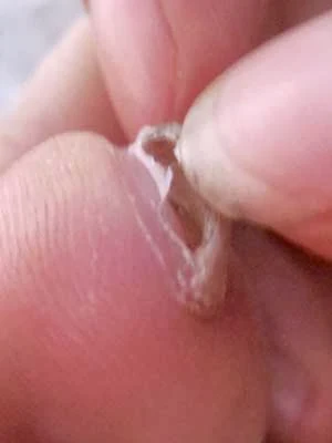 Toenail falling off or onychoptosis