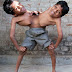 Unidos por la cintura, comparten cuatro brazos y dos piernas (Info + Fotos)