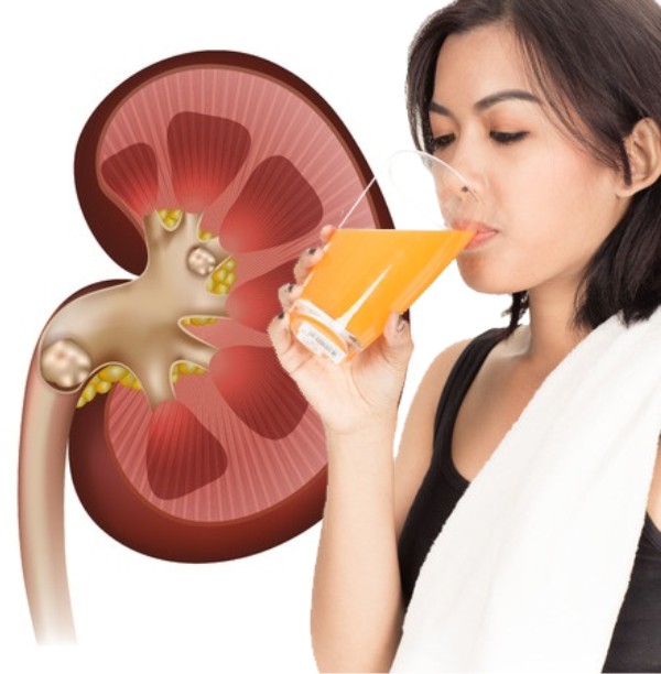 Prevent Kidney Stones! with orange juice Benefits & Healthy Lifestyle
