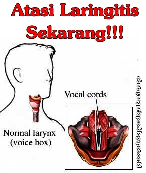 Obat Laringitis Obat Laringitis