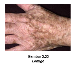 Faktor Penentu Warna Kulit, Fungsi Melanin, Kelainan pada Proses