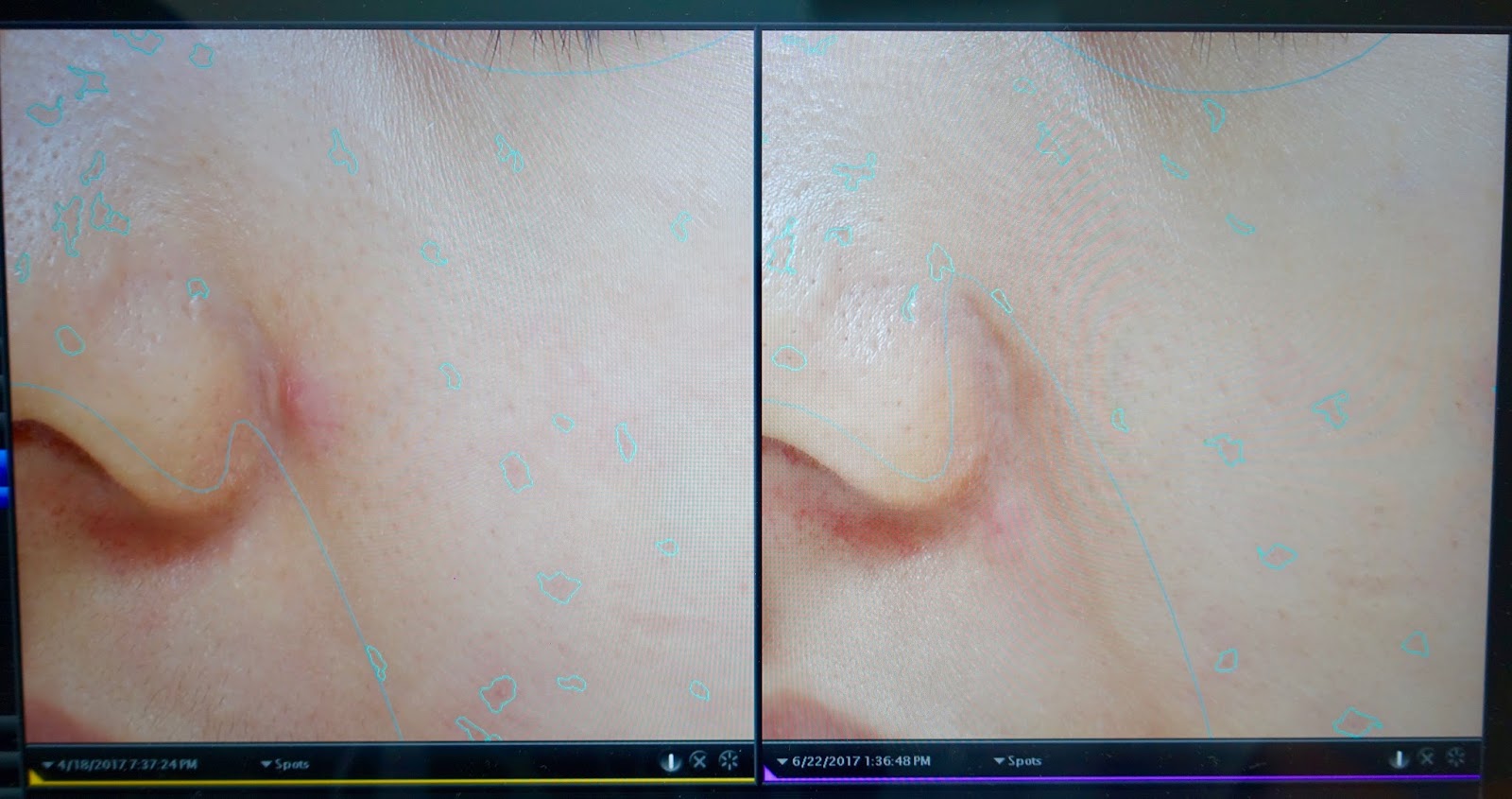 Chloe WL Face On Clinic Acne Treatment Review