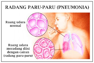 Penyebab & Obat Radang Paru Paru / Paru Paru Basah ( Pneumonia ) Alami