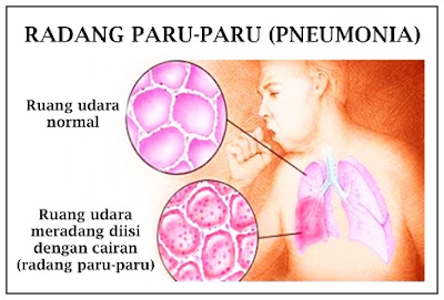 Image result for radang paru-paru