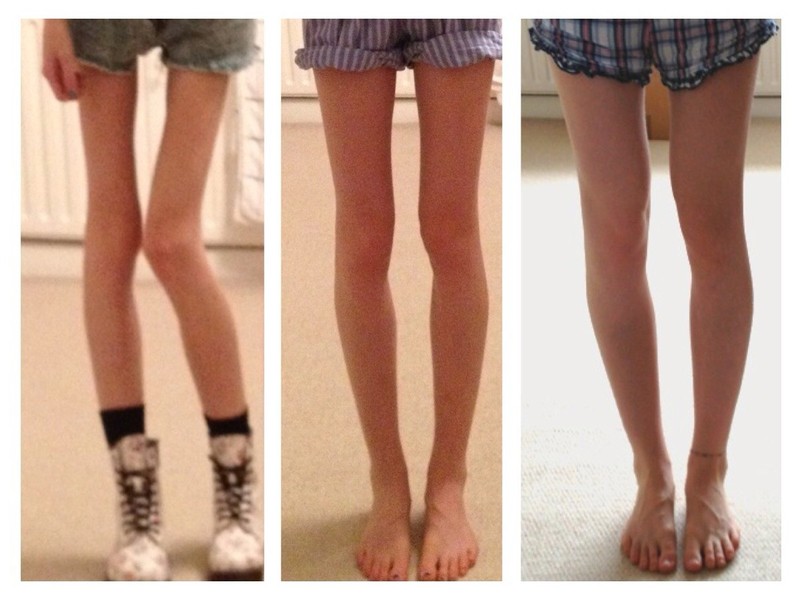 Extreme Thinspo Real Girls August 2013