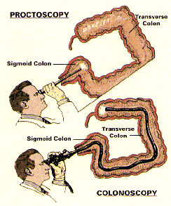 Длина колоноскопии. Аппарат колоноскопии диаметр трубки. Трубка для введения в кишечник.