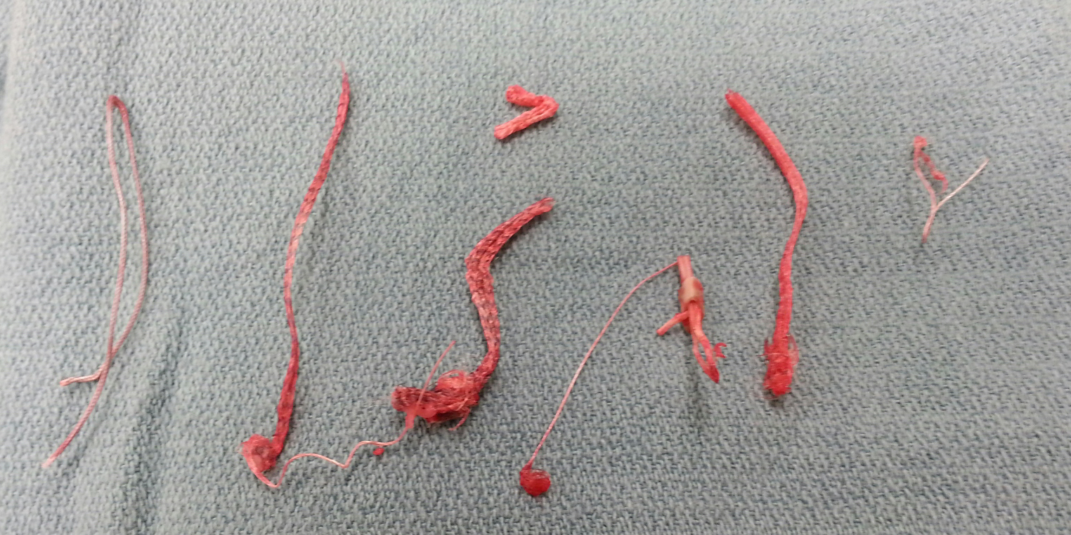 UW Shoulder and Elbow Academy Failed rotator cuff surgery in a 70year old the smooth and