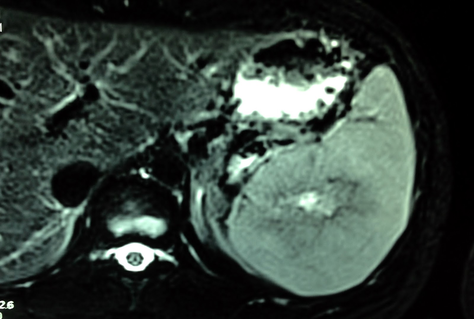 VIETNAMESE MEDIC ULTRASOUND CASE 393 SPLEEN TUMOR, Dr PHAN THANH HẢI