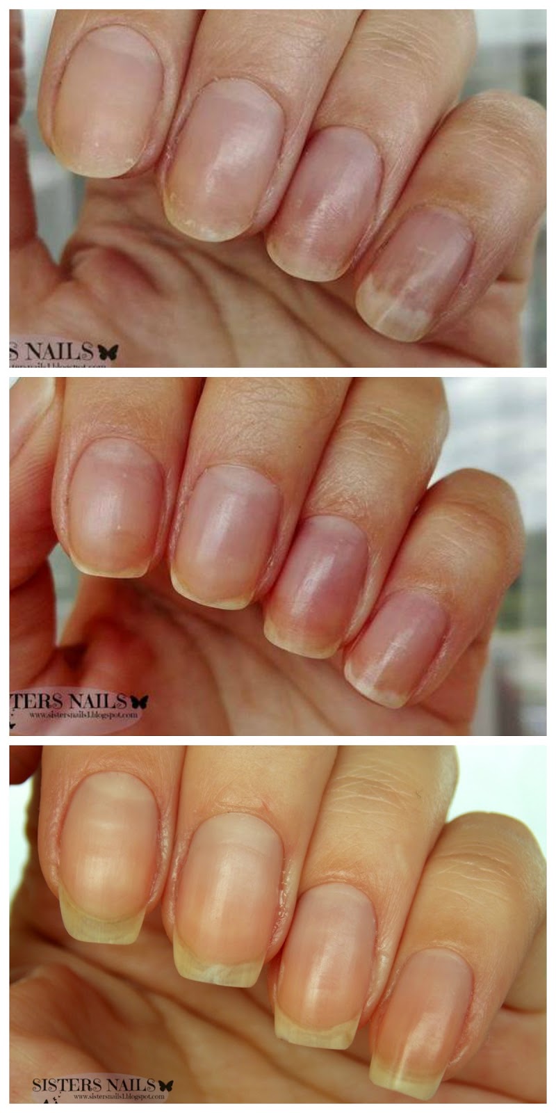 Sisters Nails Moja Walka Z Onycholiza