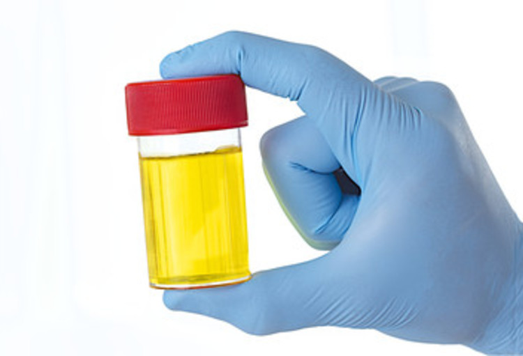 Kampf gegen Nierenversagen zusammen Gibt Foamy Urin Nierenerkrankung an