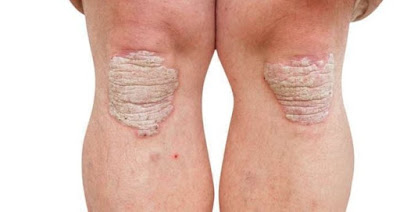 penyakit berbahaya psoriasis