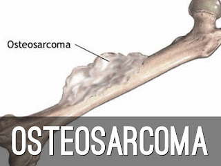 Obat osteosarcoma