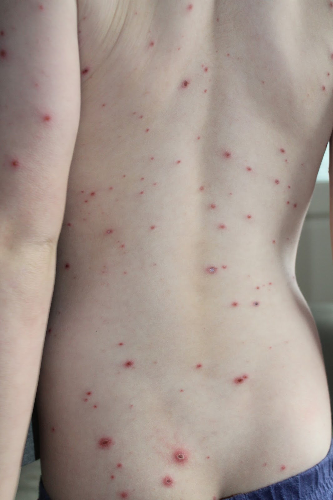 This week we have had Chicken pox!