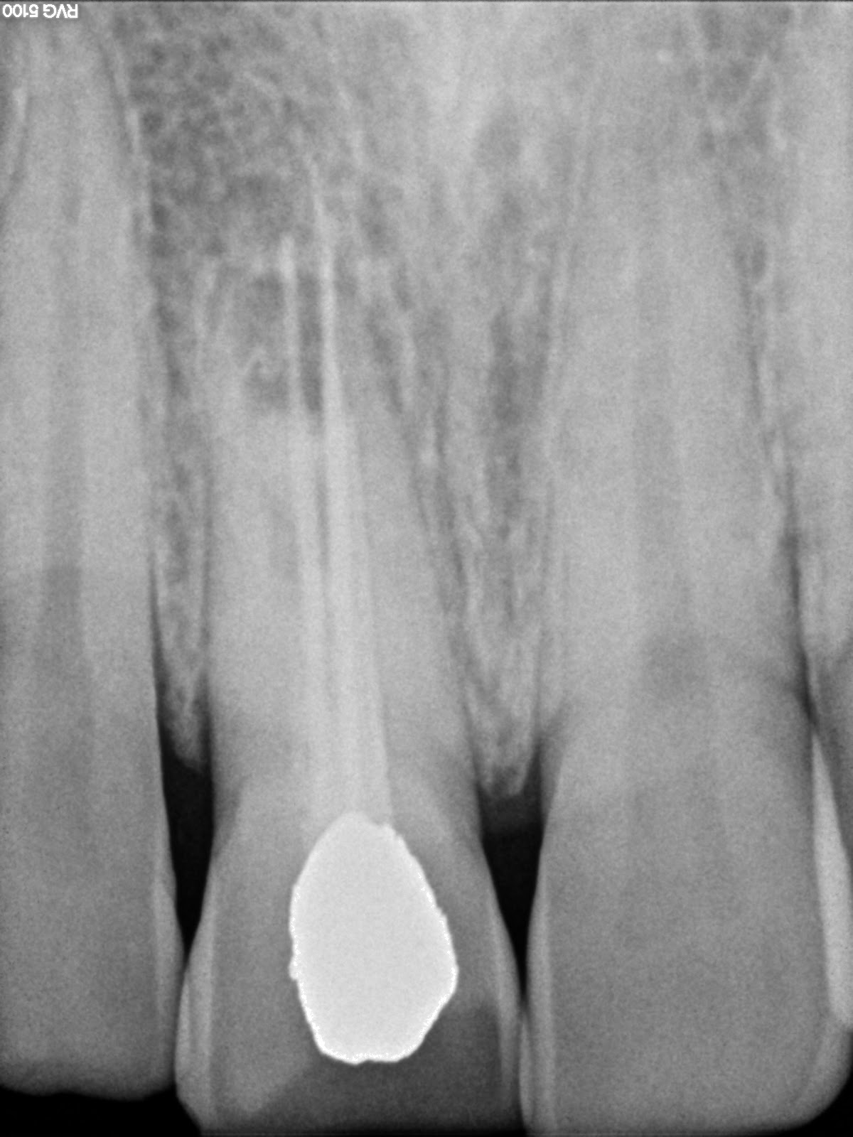 Endodontics Re rootcanal treatment with open apex central incisor