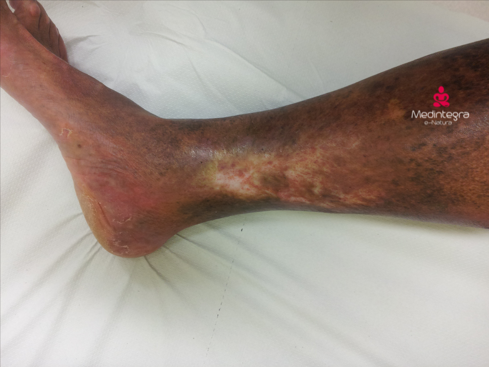 ulcera resuelta ulcera presión acupuntura