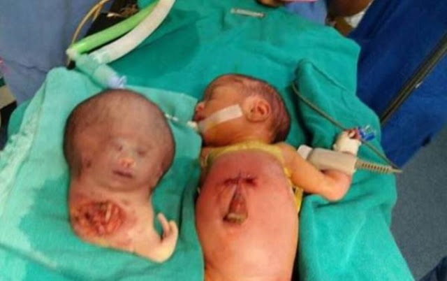 Kepala Bayi Kedua Tumbuh Diperut, Tak Disangka Saat Di Bedah Yang Terjadi Mengejutkan! Kepala Bayi Kedua Tumbuh Diperut, Tak Disangka Saat Di Bedah Yang Terjadi Mengejutkan!
