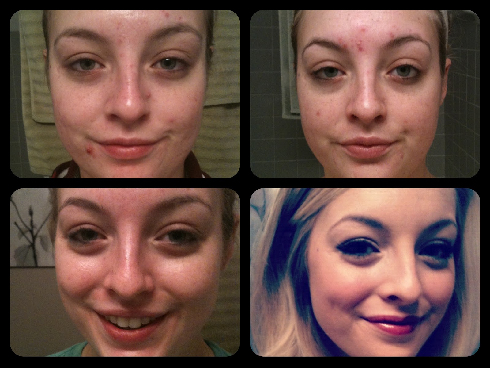 My Accutane Experience and Post-Accutane Skincare Routine