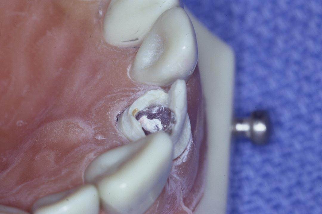 Dentistry Custom Cast Dowel Core