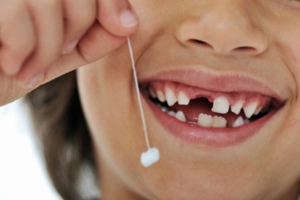 Có nên nhổ răng sữa cho trẻ em hay không?