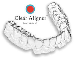 Niềng răng không mắc cài 3D Clear là gì?