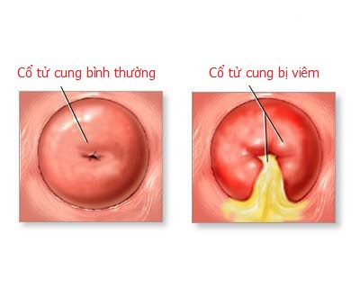 Viêm cổ tử cung vô cùng nguy hiểm cần được điều trị kịp thời