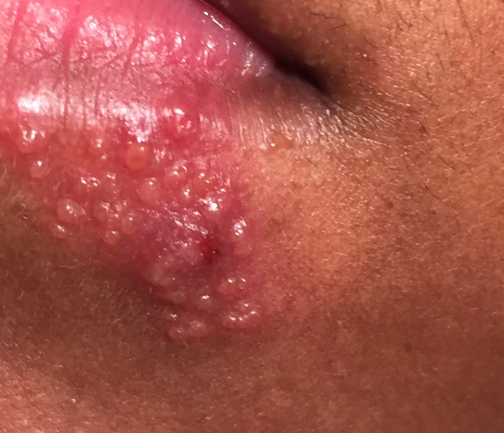 How To Treat Fever Blisters In Your Mouth Naturally How To Treat Fever Blisters In Your Mouth Naturally