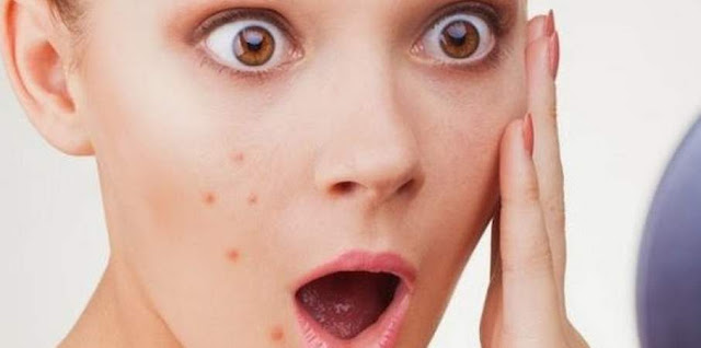Cara Menghilangkan Bekas Jerawat Secara Alami (Lengkap)