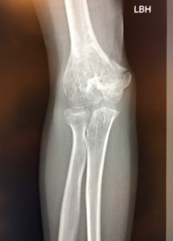 malunion distal humerus)