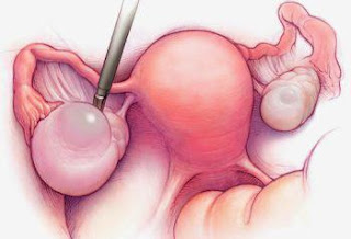 Obat Penghancur Kista Tradisional Paling Manjur Obat Penghancur Kista Tradisional Paling Manjur