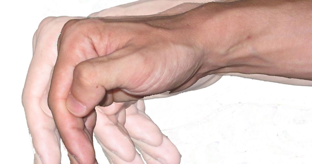 Проявление тремора. Феномен зубчатого колеса неврология. Поза просителя при болезни паркинсона. Тремор симптомы. Тремор ног у взрослых.