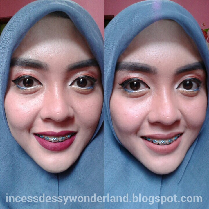 50+ Terkini Warna Karet Behel Yang Bagus