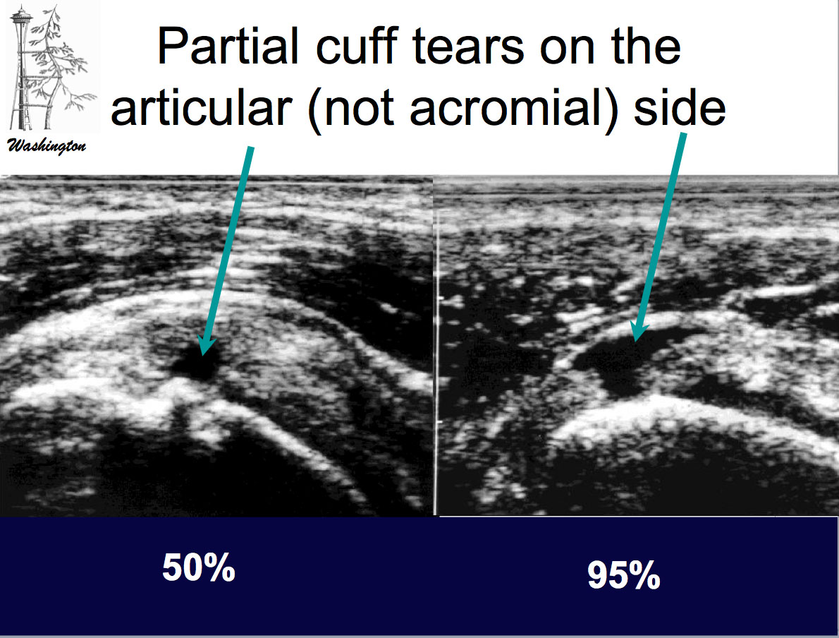 UW Shoulder and Elbow Academy Rotator Cuff 7 Xray, ultrasound and