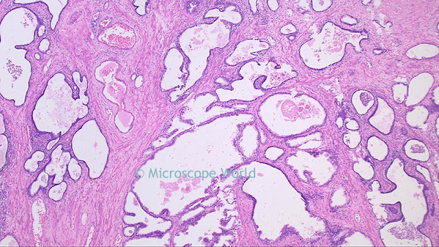 Microscopy image of prostate cancer at 40x.