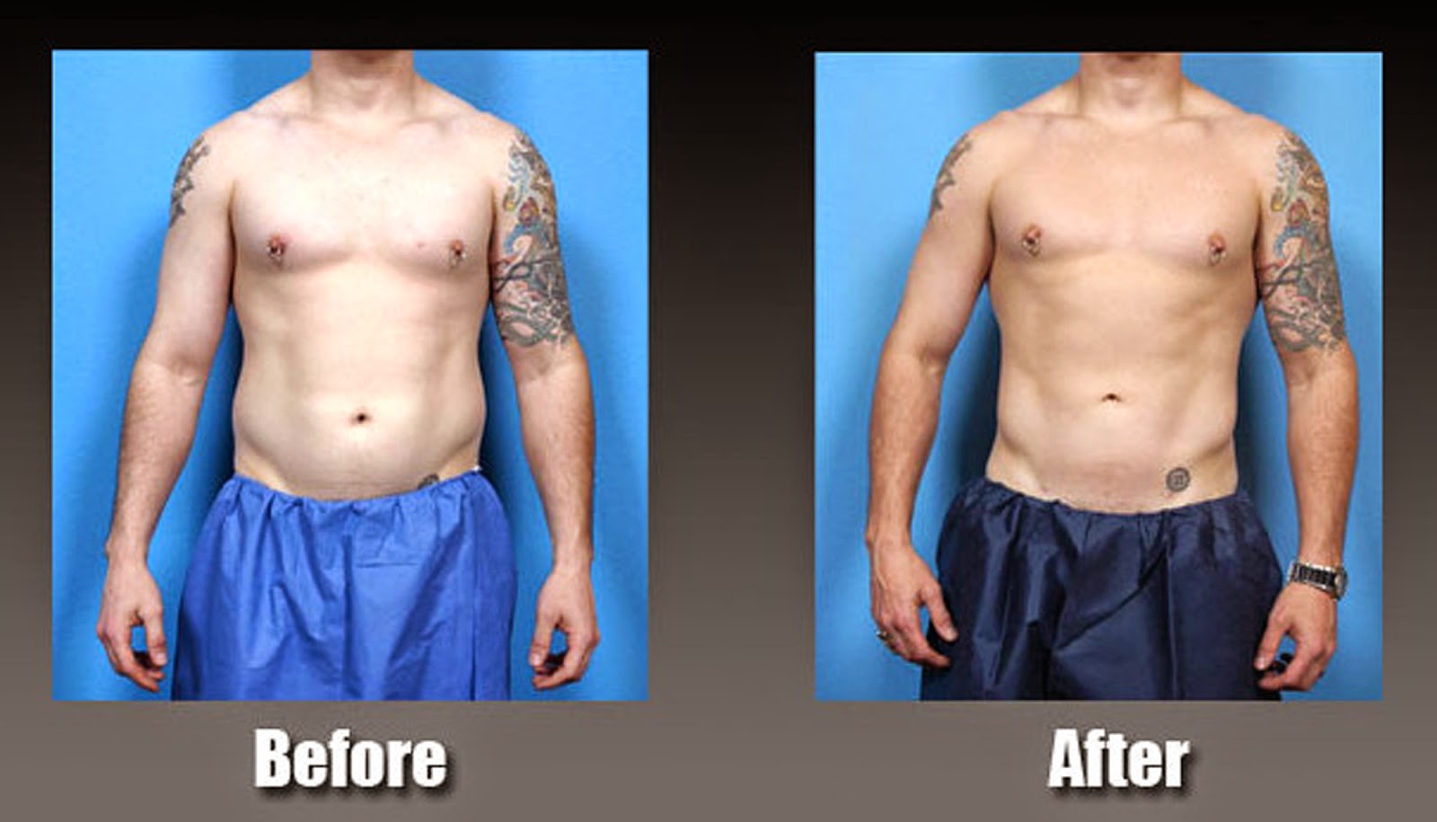 Liposuction Las Vegas Cost