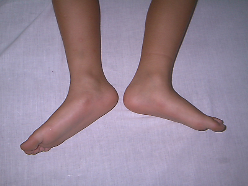 artroza articulației gleznei și a picioarelor plate degetul dureros pe mână în articulație